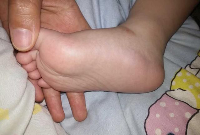 氨基酚|孩子出现发烧症状,家长要怎样处理?赶紧学起来