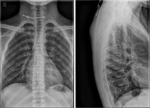 椎体|脊柱常见肿瘤及肿瘤样病变的几种影像学表现，你都见过吗？