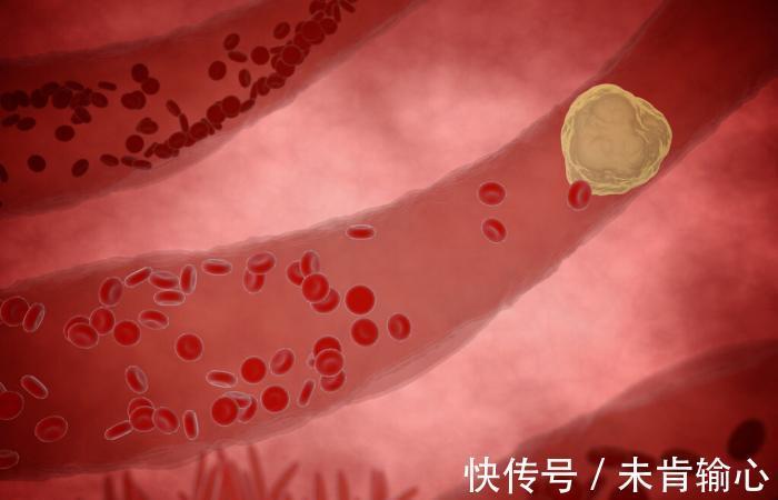 胆固醇|45岁男子晕倒猝死,生前烟酒不沾,医生叹息:一事怎能天天做