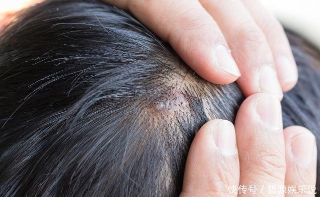 头皮上有白色的东西，很多人都喜欢抠，这些到底是什么东西？