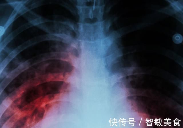 肺结节|查出肺结节,担心是肺癌若是这2种情况,先放宽心