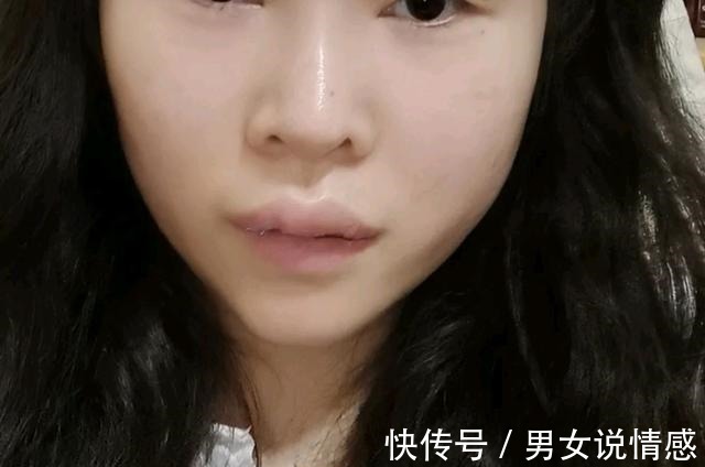 唇部 做什么医美改善凸嘴效果最快!