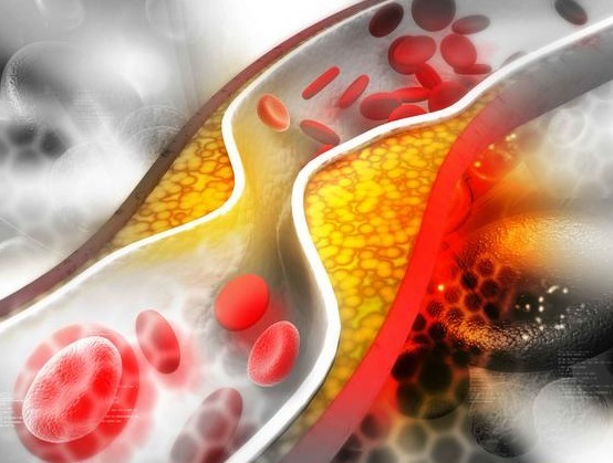 血管|血脂高不高腿先知道,腿部出现4种状况,可能是血脂超标要重视