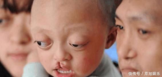 小余|夫妻先天缺陷坚持生孩子, 生下的孩子遗传了家族所有缺陷