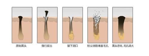 清洁|长了“黑头”到底能不能挤？很多人都搞不懂，难怪黑头越去越多
