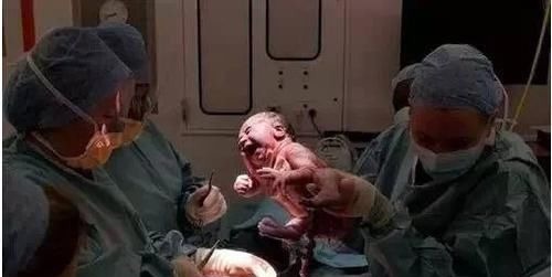 宝宝|超预产期5周,准妈还在家“待产养胎”,取出孩子后医生无奈摇头