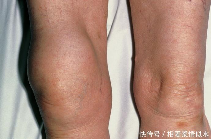 关节|一块“仙人掌”,10天巧治膝盖疼,消除关节积液,滑膜炎消失了