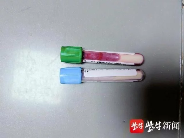 高脂血症胰腺炎患者血标本内厚厚的白色脂肪