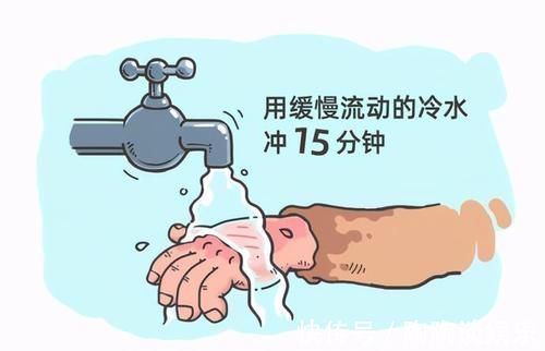 水龙头|孩子被烫伤怎么办?父母学会这4个急救步骤,连医生都会称赞
