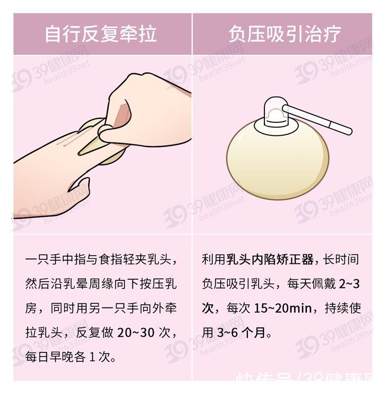 乳房|什么是“乳头内陷”？要怎么治疗？2个原因，可能让它暂时消失