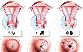 hpv|宫颈癌多是拖出来的4类女人更容易被盯上,尽早查HPV