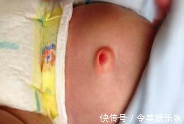 咋回事|7个月宝宝肚脐肿大险丧命,送医检查后,丈夫怒摔妻子手机,咋回事
