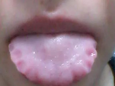 炙甘草|“齿痕舌”摊上大事了！是癌变征兆老中医支3招帮你健脾祛湿！