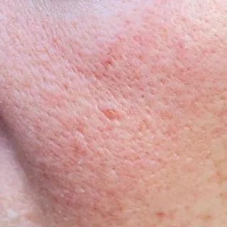 缩毛孔效果不大？对抗毛孔问题还是得来点硬的