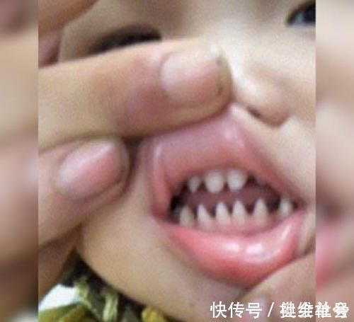 鲨鱼牙|萌娃张口的一瞬间令人诧异,牙齿像“鲨鱼牙”,网友:父母惹的祸