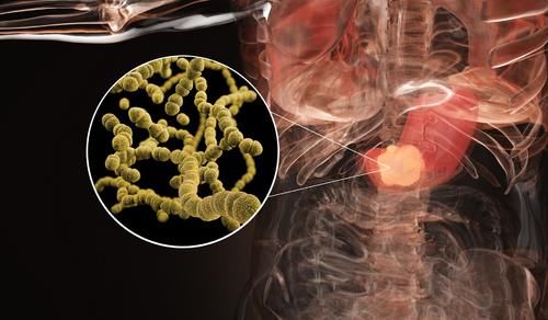 预防胃癌，做胃镜检查很关键，早发现、早治疗