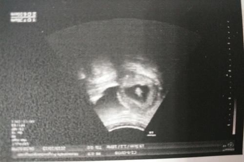 B超次数太多，会影响到胎儿健康吗？关于B超，医生给你说清楚