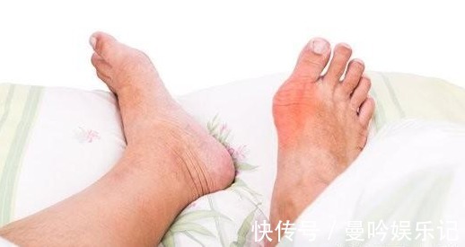关节|尿酸高的人,常有四个共性,提醒:三个方法,让尿酸蹭蹭往下降