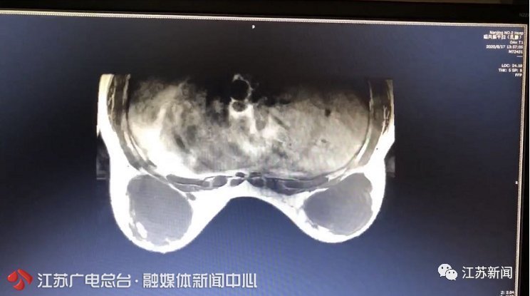 女子胸部取出1000毫升变质物只因25年前一个冲动的决定…