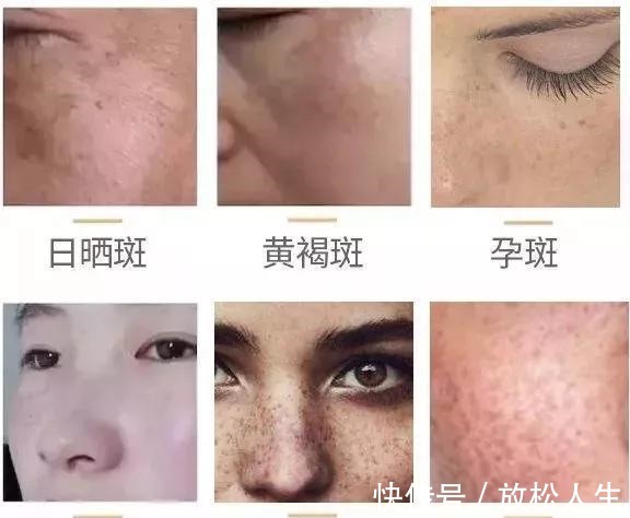老年斑|药店有种“不起眼”的祛斑霜,雀斑老年斑都清除,美白祛斑还嫩肤!