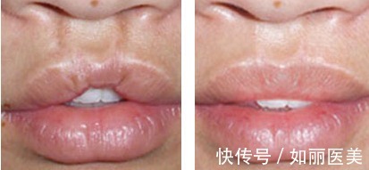 玻尿酸 性感双唇如何拥有?这些常见的唇部整形手术方法你都知道吗?