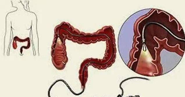  癌变|46父女双双查出肠癌，医生坦言：这“玩意”吃多了，肠道易癌变！