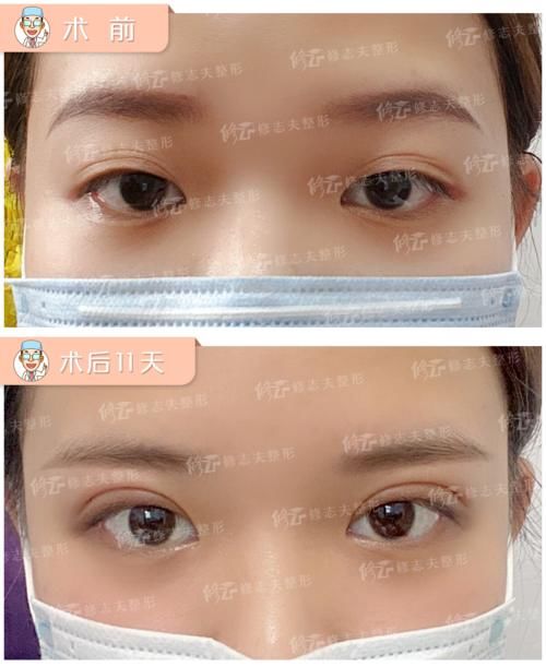 你的眼皮都有几层了?