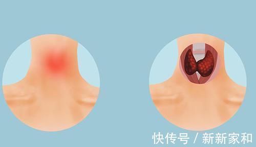 甲状腺|硬是把结节拖成了癌症女子查出“最懒的癌”，丝毫不当回事