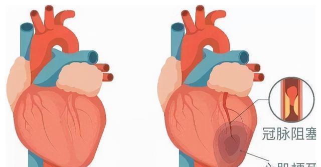 心血管疾病|不吃药，真能降血脂吗？医生确认了：能！但要认准这2种高血脂