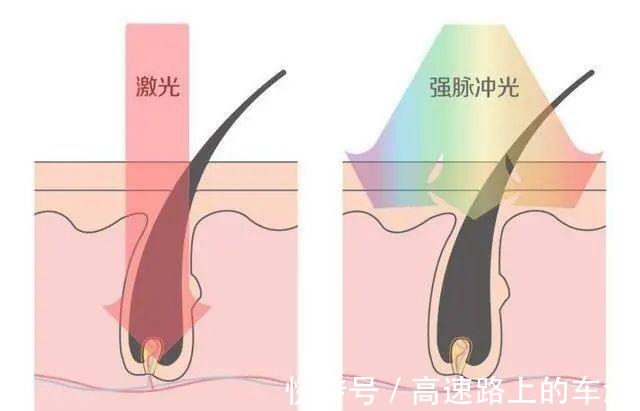 精准 美莱光子嫩肤和激光种类这么多，到底怎么选