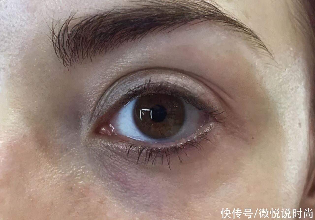 黑眼圈很严重怎么办？怎么拯救特别严重的黑眼圈？