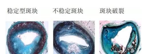 医生|动脉粥样硬化有何危害？是否真的能够被逆转？听听医生怎么说