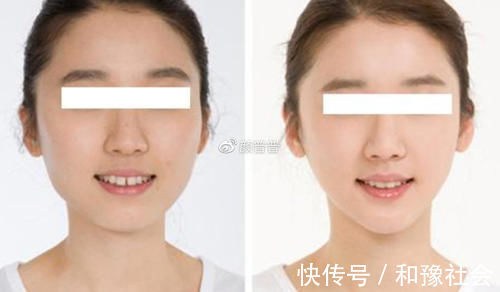 成形术|颏成型术和假体垫下巴有啥区别?下巴短还后缩做哪个好?