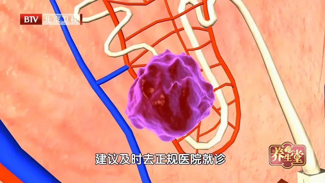 肾癌|尿酸只高一点,也可能得肾癌!少做这三件事,把尿酸降下来~