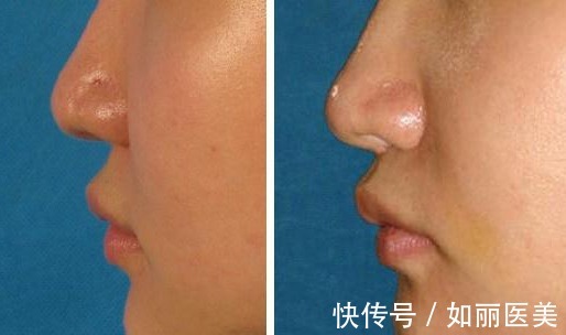 人中 人中长=很显老?“人中缩短手术”可以做吗?