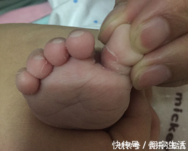 宝宝|新生儿双脚大面积蜕皮，宝妈火急火燎跑医院，医生看到却很淡定