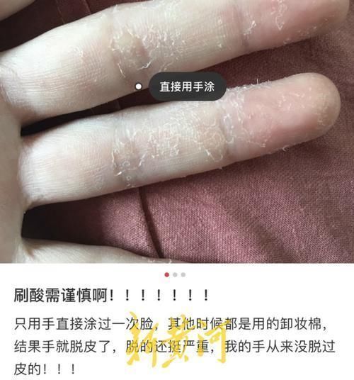 美容|全网都在刷酸?美容博主纷纷分享教程，国家药监局却这样说