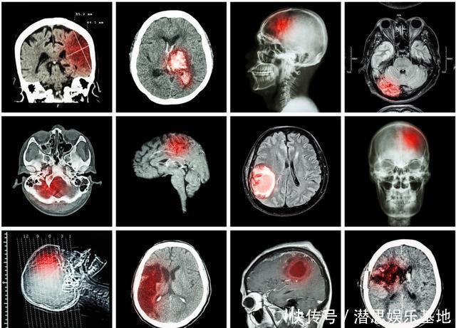 病人|为什么中国脑梗病人多?医生感慨:和肥肉无关,厨房这一物是祸首