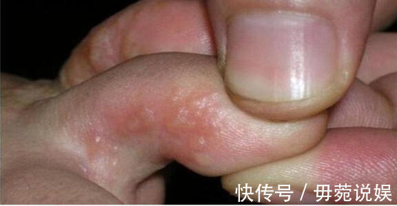 脚癣|生姜、盐水巧治脚气,斩草除根!附老中医治脚气名方、验方