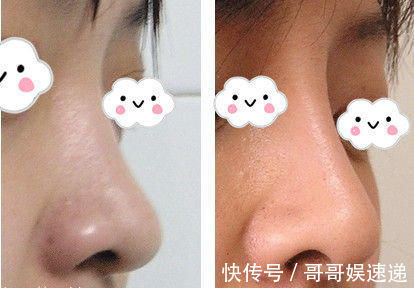 隆鼻|鼻部整形真的安全吗?假体隆鼻材料硅胶和膨体哪个更自然持久?