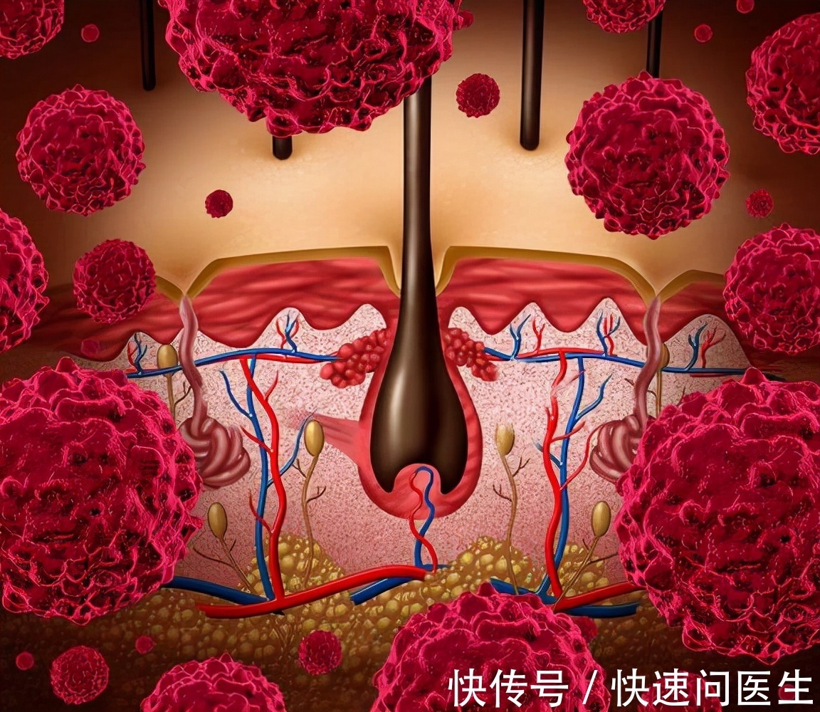 慢性疾病|未来不想让癌症找上自己,现在起做好5件事,或能预防癌症