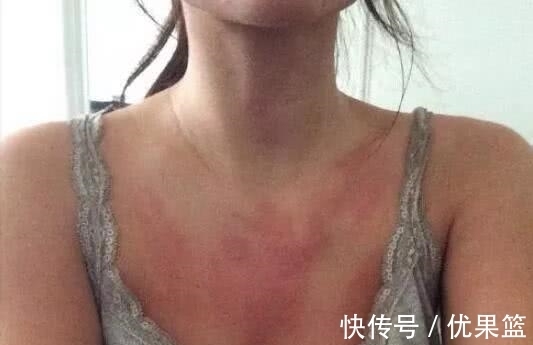 女孩|女孩对水过敏每次洗澡都很痛苦,并且连自己的汗液和眼泪也过敏