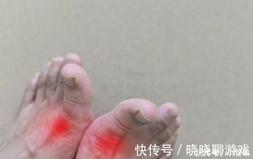 尿酸|痛风多喝2种水就够了, 多喝一口尿酸降50, 痛风不再发作