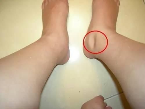 身体这些异常表现没留意, 当心会慢慢发展成肾衰