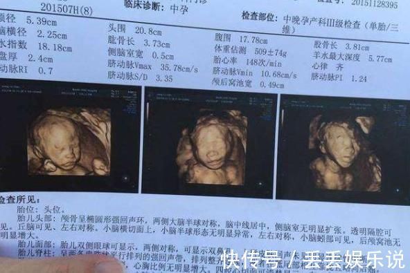 排畸|不想生个“傻儿子”,孕期有三项检查不可少,准妈咪别不当回事