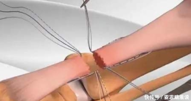 过程|病人断掉的“筋”是怎么接起来的看完动画演示过程,总算明白了