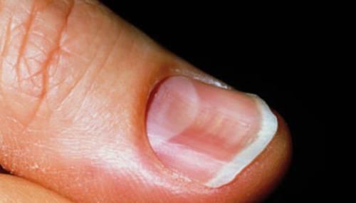 4种指甲的变化,3种情况可要注意,你平时关注过指甲吗