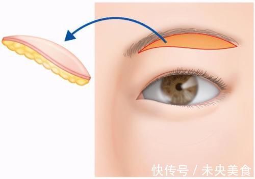 手术 提眉手术后,会不会留下睡觉“闭不上眼”的后遗症?医生告诉真相