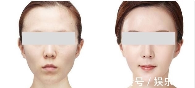 面部填充 王小民教授:做完面部填充后,脸真的变小了?