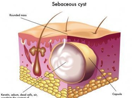 到底|古代名将得了“背疽”之后,往往难逃一死,它到底是一种什么病?